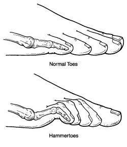 What is Hammertoe