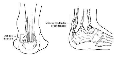 Achilles Tendon