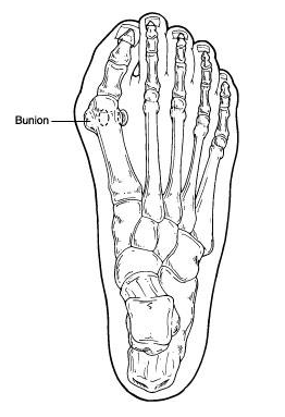 What causes a bunion, and how is it treated?