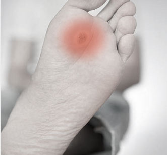 Foot Care Treatment for Plantar Wart