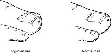 What is an Ingrown Toenail?