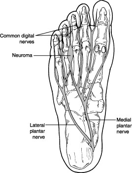 What is Morton’s Neuroma