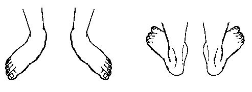 Pediatric Flatfoot