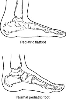 Pediatric Flatfoot