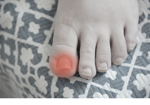 Nail Fungus and Treatment